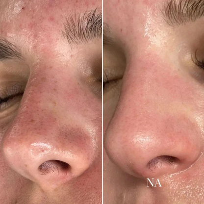 ClearSkin™ | Hudorms- & Poreplejeværktøj