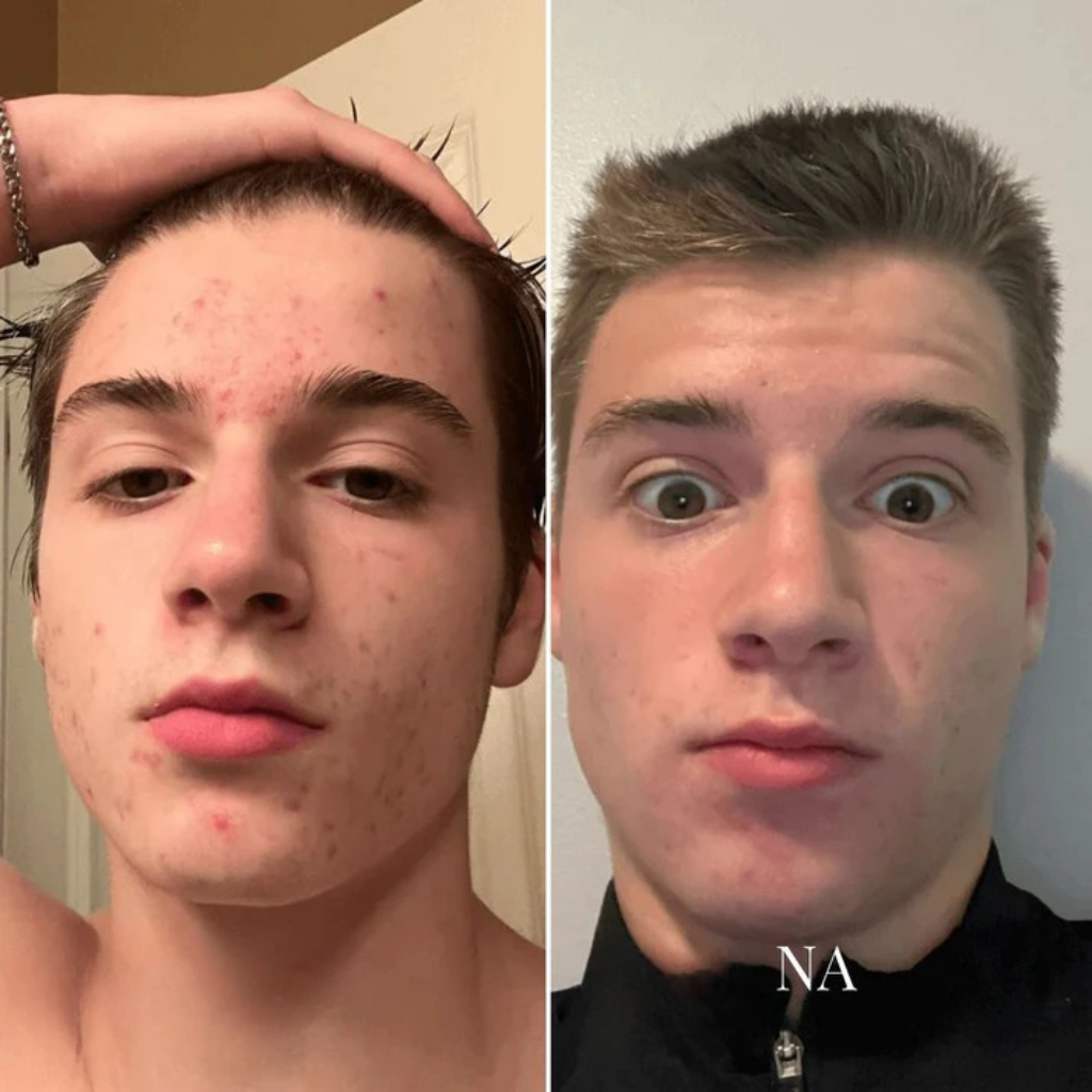 ClearSkin™ | Hudorms- & Poreplejeværktøj