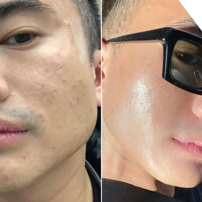 ClearSkin™ | Hudorms- & Poreplejeværktøj